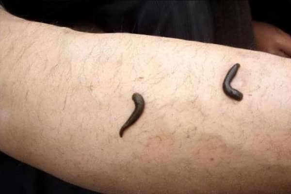梦见蚂蟥钻到肉里是什么意思